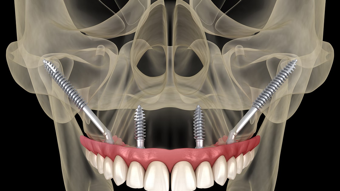 Zygoma Implants Graphic